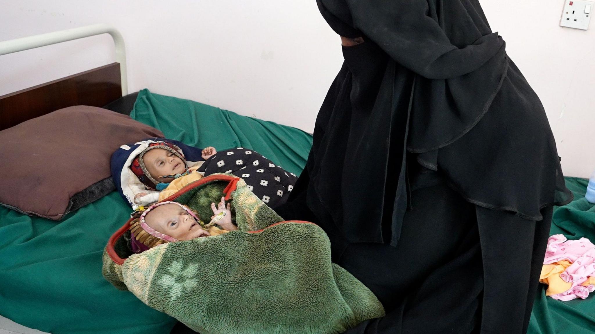 Twins at the Edge of Survival – Yemen’s War‑Wounded Children